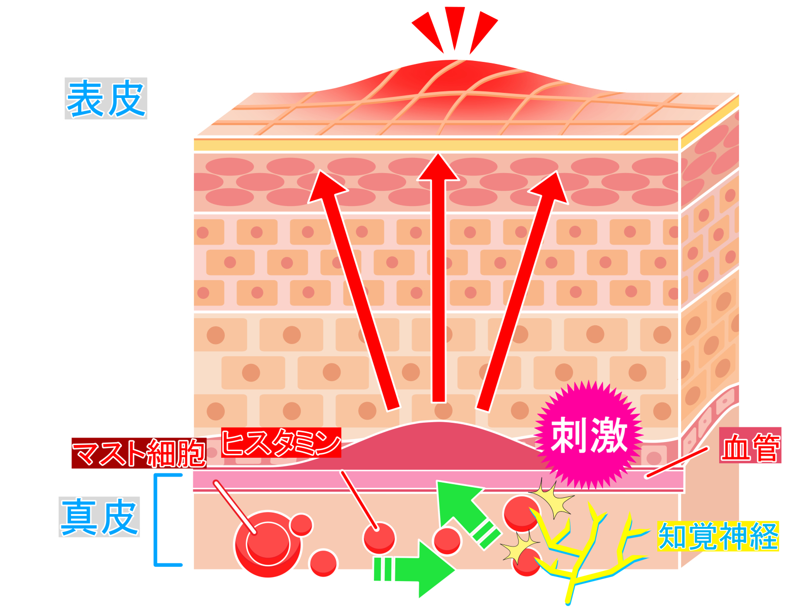 蕁麻疹